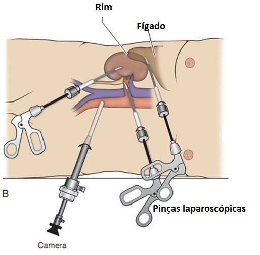 Nefrectomia videolaparoscópica: representação esquemática.