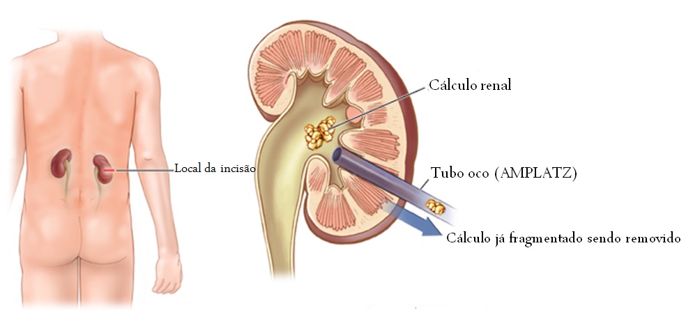 Cirurgia renal percutânea: o cirurgião introduz um espécie de tubo dentro do rim, através do qual as pedras são removidas.