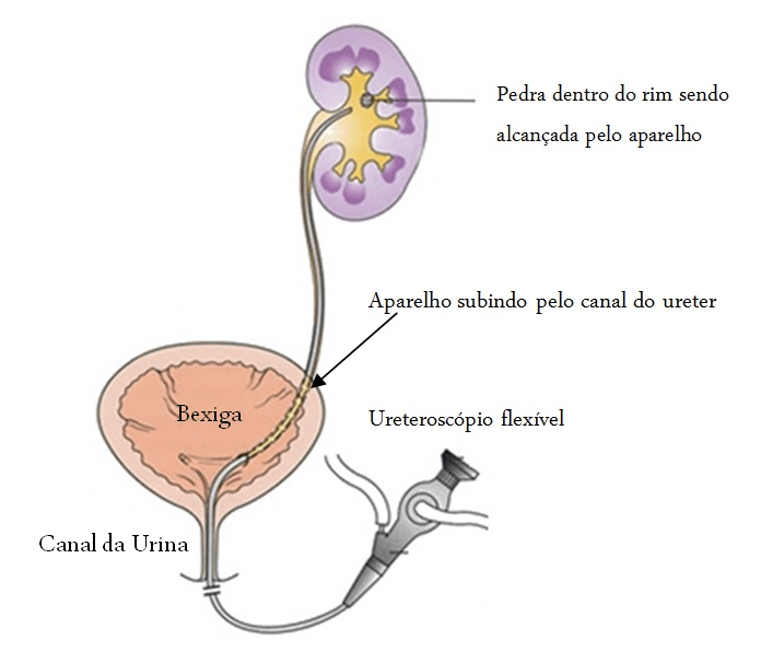 Desenho esquemático do procedimento para remoção de cálculos nos rins (Ureterorrenolitotripsia com laser