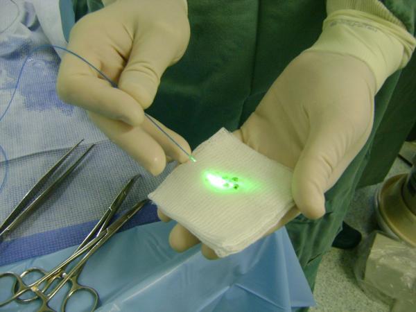 Fibra do Holmium laser utilizada para quebra dos cálculos urinários.