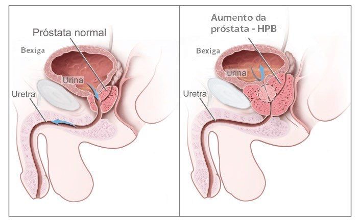Diferença próstata normal e com Hiperplasia.