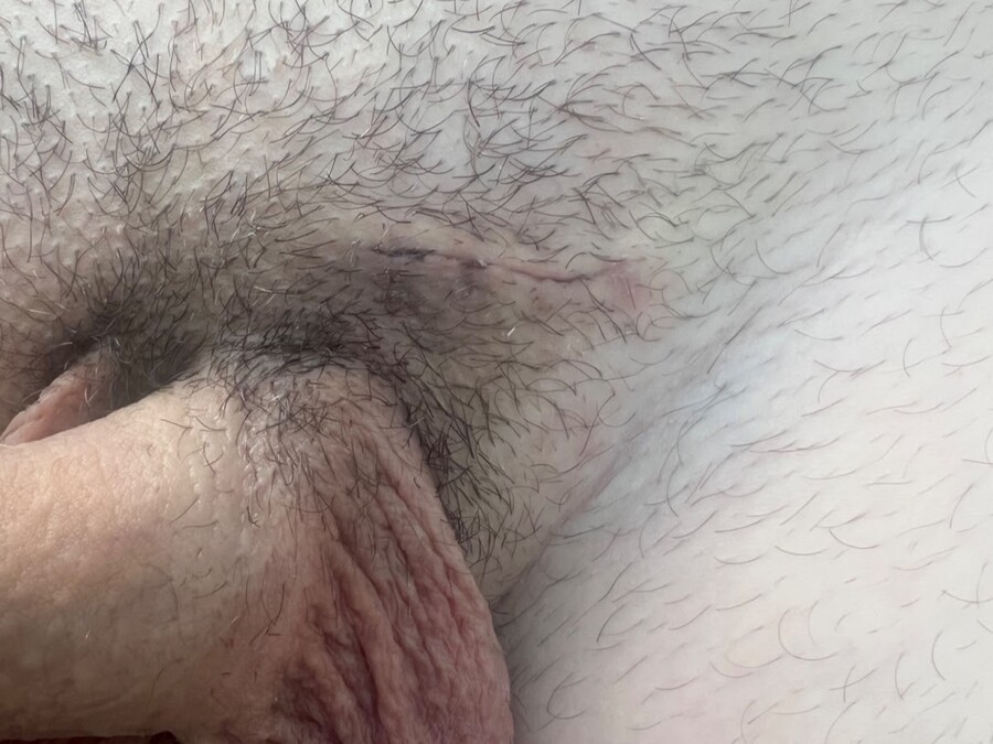Cicatriz de varicocele.