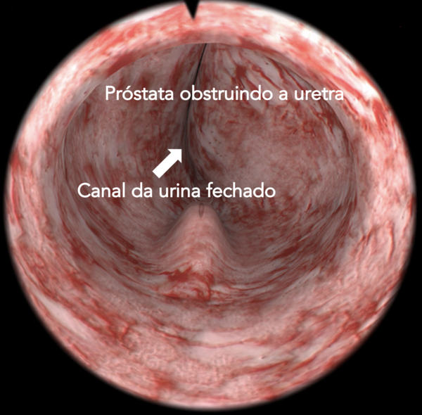 Imagem recriada em computador demonstrando a visão que o cirurgião tem da próstata obstruindo a uretra. 