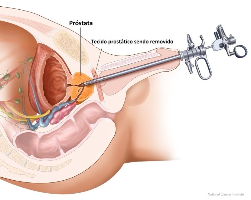 Ressecção Transuretral de Próstata